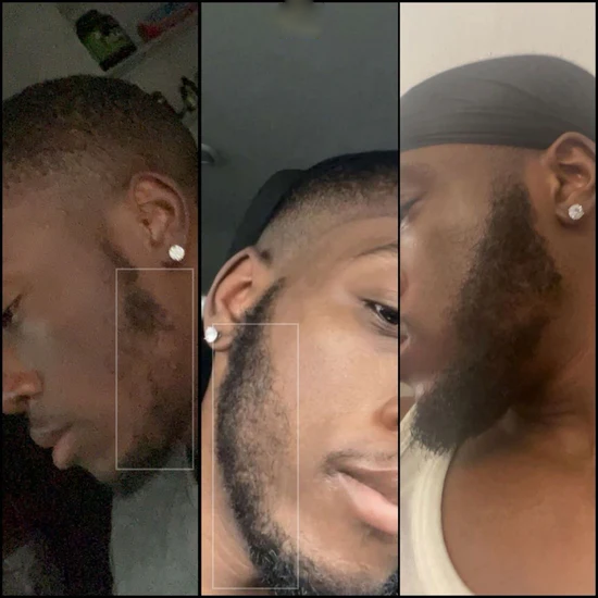 1 Mois Kirkland 5% Solution et Derma Roller