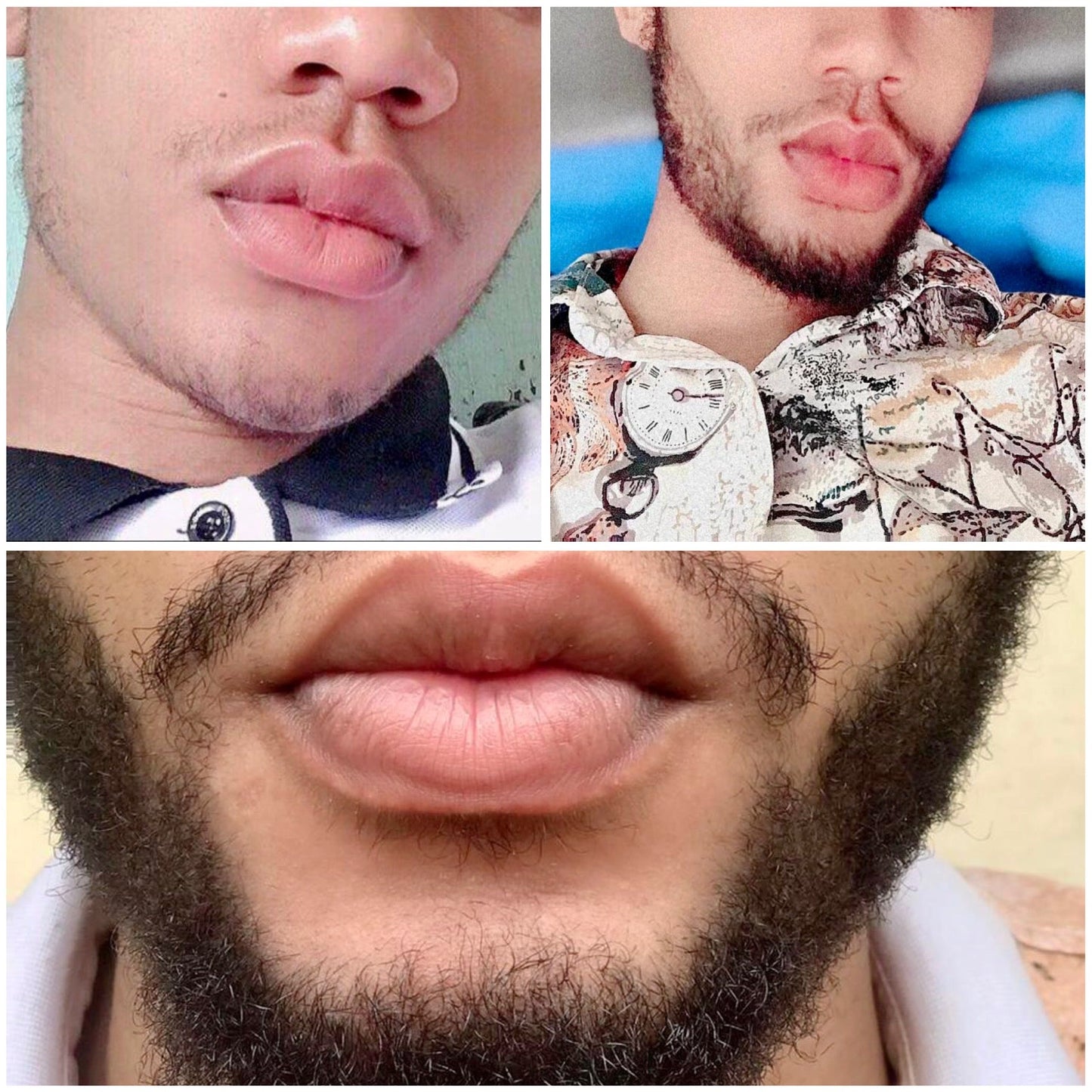 1 Mois Kirkland 5% Solution et Derma Roller